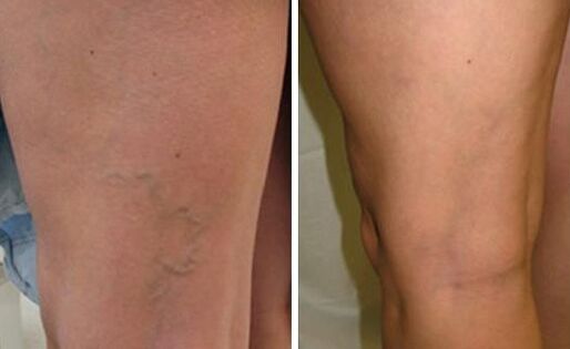 Neoveris helps prevent further development of varicose veins