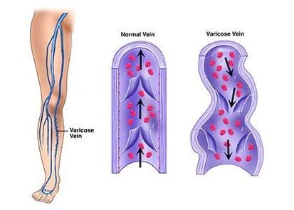 Neoveris prevents the development of venous lesions