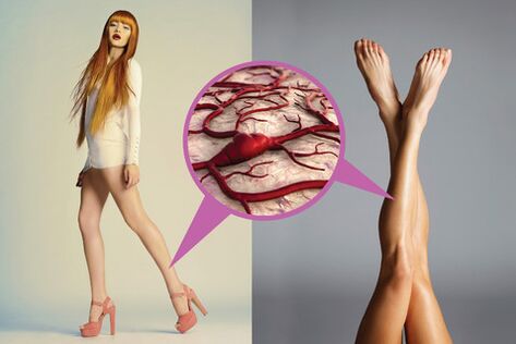 Veins on the legs