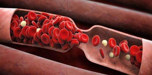 Prevent blood clots