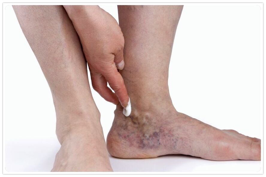 Benefits of procedures for veins