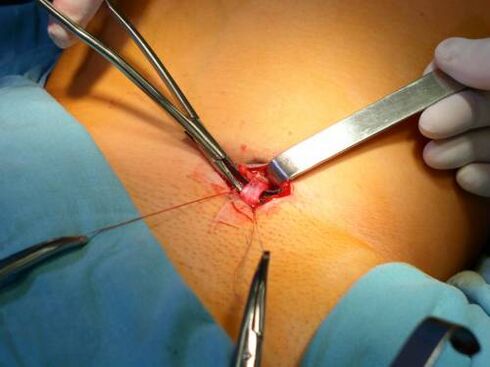 Ovalectomy