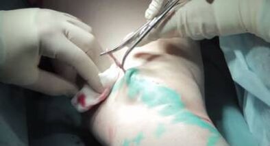 Surgical intervention