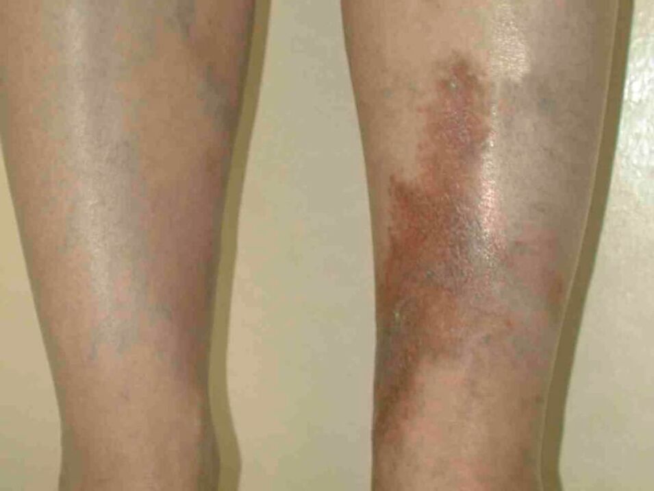 The stage of varicose veins