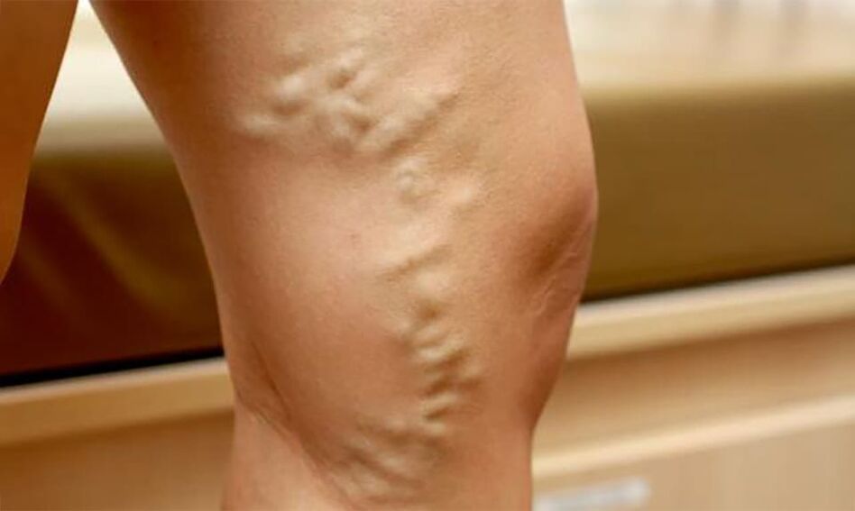 Varicose veins on the legs