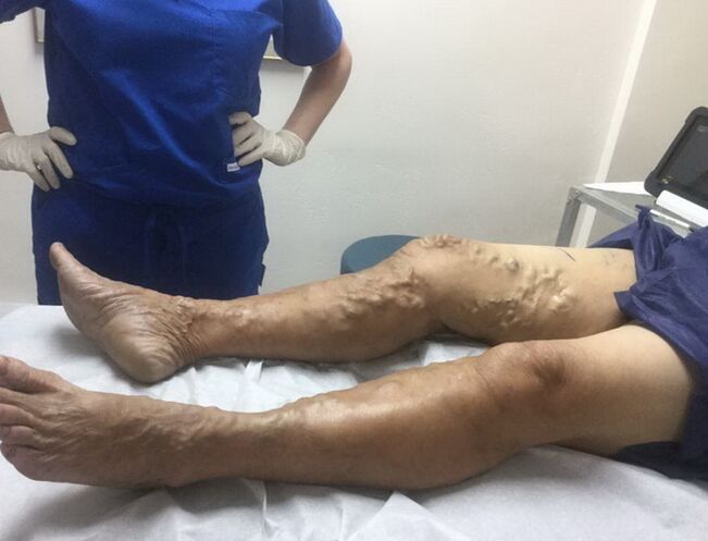 How to identify signs of varicose veins