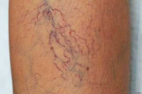 Why are varicose veins dangerous