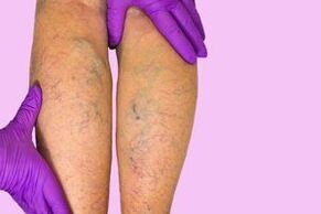 Varicose veins in legs