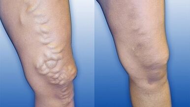 Signs and symptoms of varicose veins in the legs