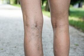 Symptoms of varicose veins in legs