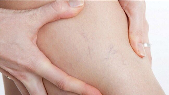 Spider veins on legs are a sign of varicose veins