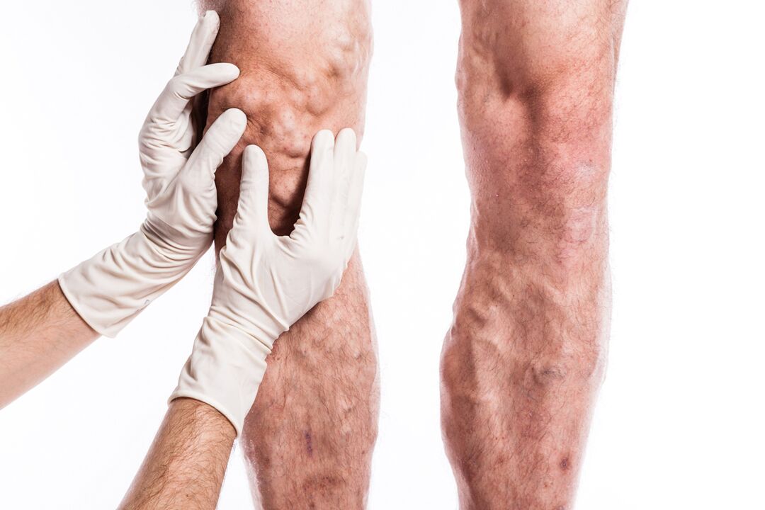 Phlebologist examining leg of patient with varicose veins