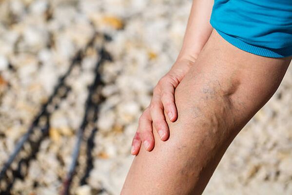 Varicose veins in legs