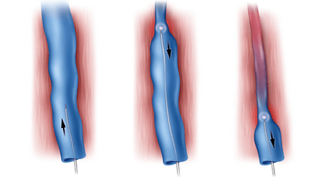 Radiofrequency ablation as a treatment for varicose veins