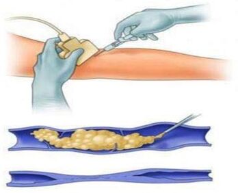Sclerotherapy is a treatment for varicose veins