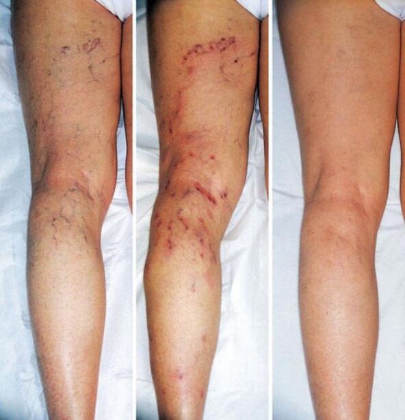Stages of varicose veins in lower limbs