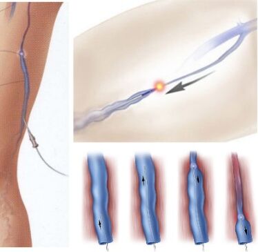 Treatment for Varicose Veins – Endovenous Laser Coagulation