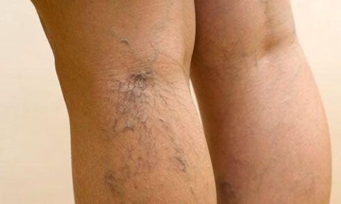Varicose veins in legs
