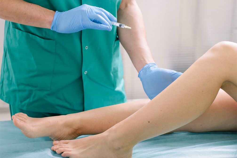 Sclerotherapy to remove varicose veins