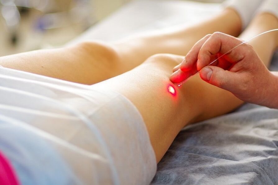 Laser treatment for varicose veins