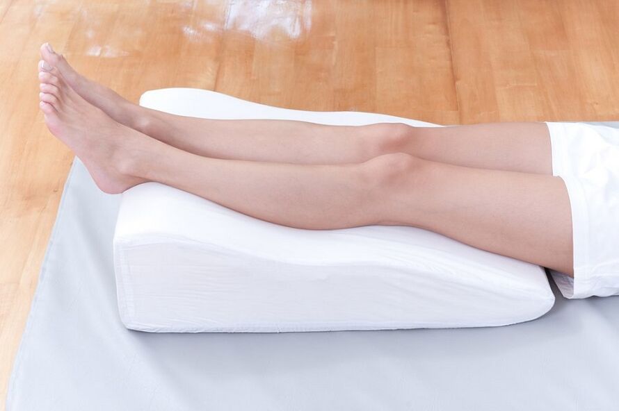 Varicose veins in legs
