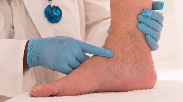 Doctor checks varicose veins in legs