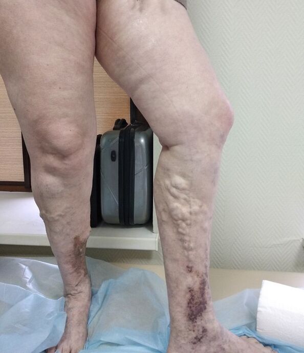 Varicose veins in legs