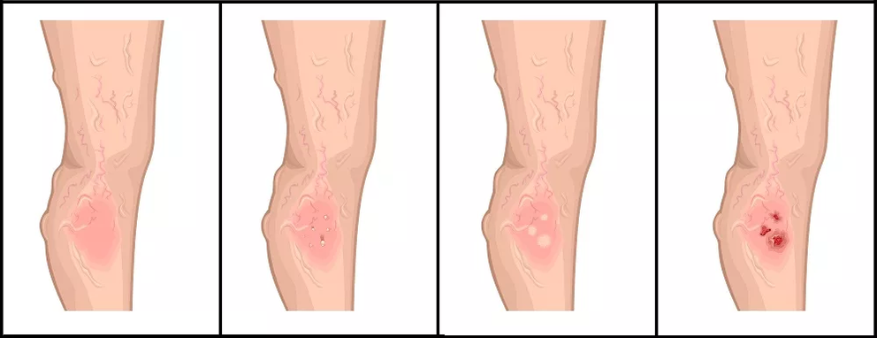 Stages of development of nutritional ulcers in venous pathology