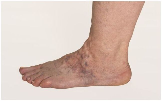 Varicose veins in the legs in men with trophic ulcers