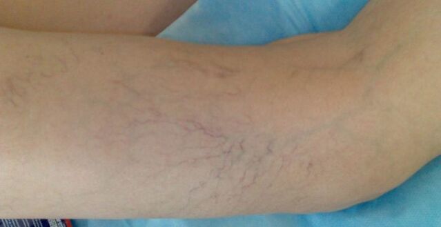 Varicose veins in the legs