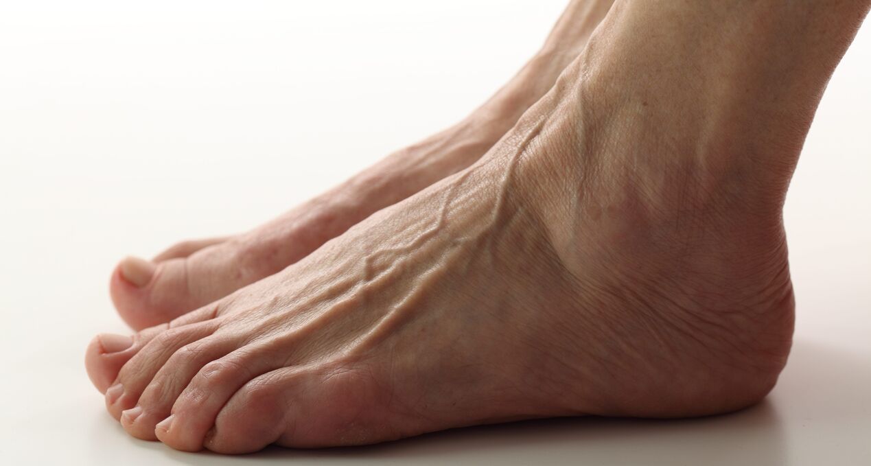 Varicose veins in the legs