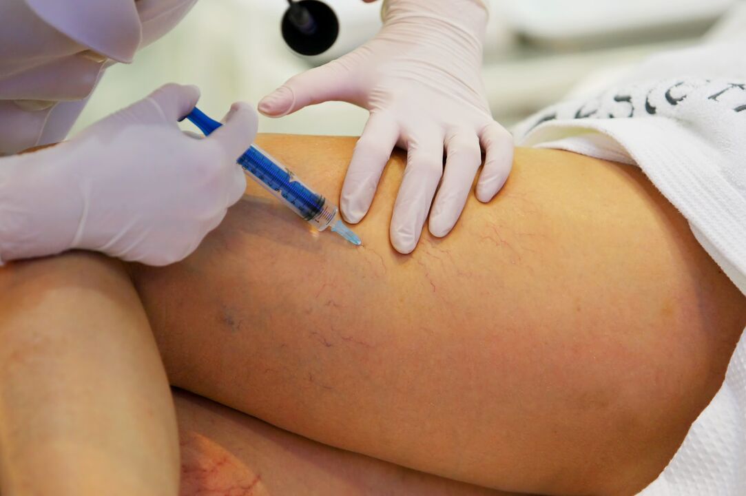 injections for varicose veins