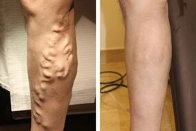 Results of surgery to remove varicose veins in the legs