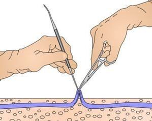 Veneectomy - removal of part of the veins affected by varicose veins