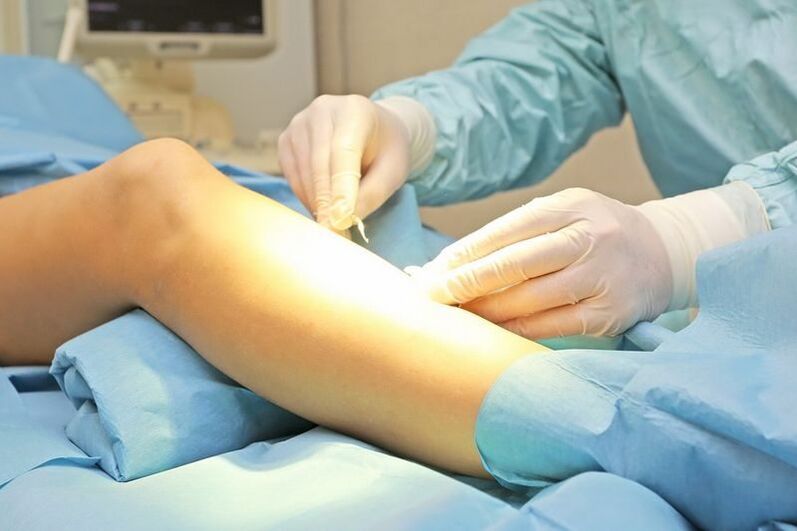 surgical removal of varicose veins