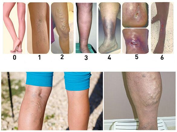 Developmental stages of varicose veins of the lower extremities