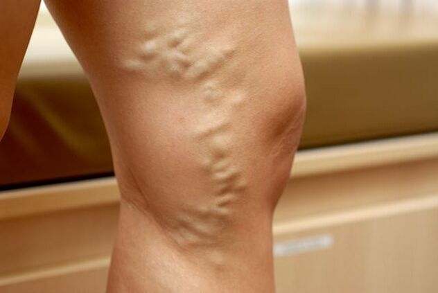 Leg vein protrusion deformation, varicose veins stage 3