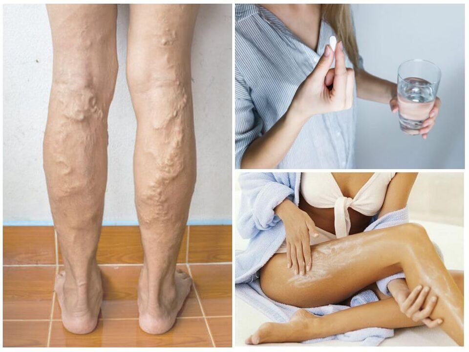 Varicose veins of lower extremities and their treatment