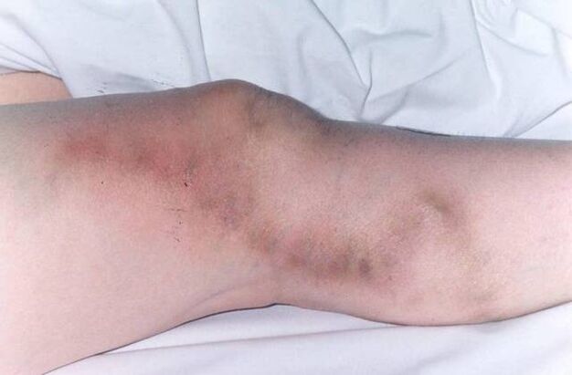 Thrombophlebitis with advanced varicose veins