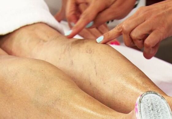 Female lower extremity varicose vein examination