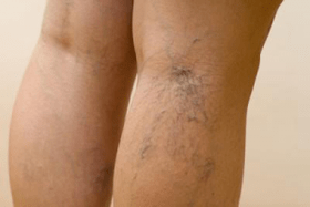 photo of varicose veins on legs