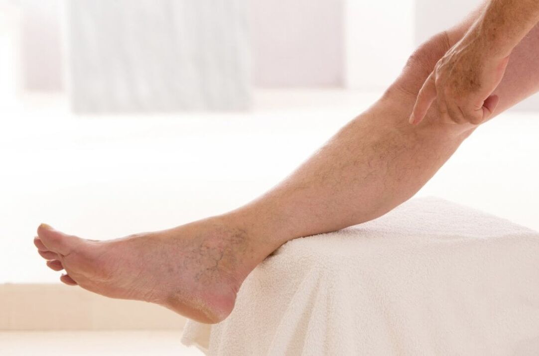 Symptoms of varicose veins in the legs