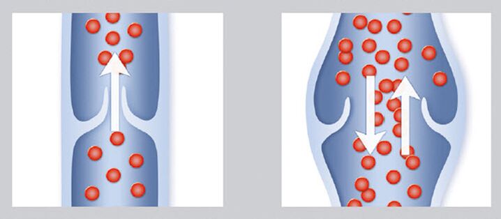 Healthy and damaged vein valves