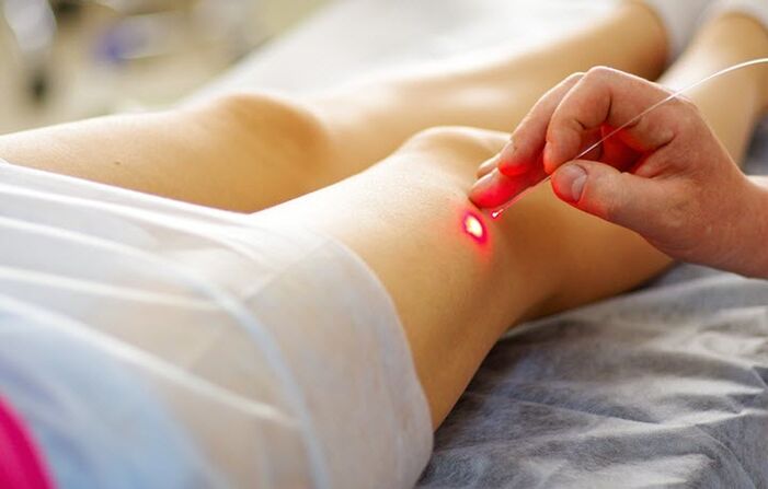 Laser treatment for varicose veins