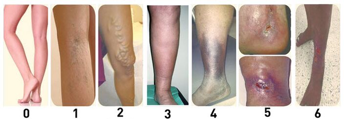 stages of varicose veins